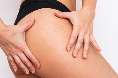 Stretch marks: How to make them disappear naturally