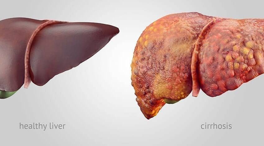  Liver cirrhosis : A silent illness